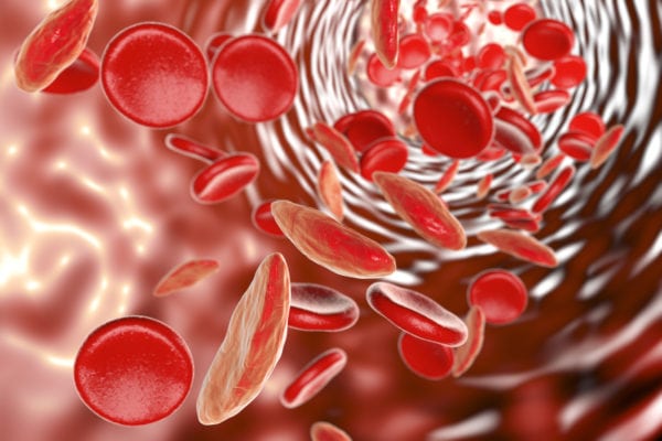 When Will We Cure Sickle Cell Disease? - Black Health Matters