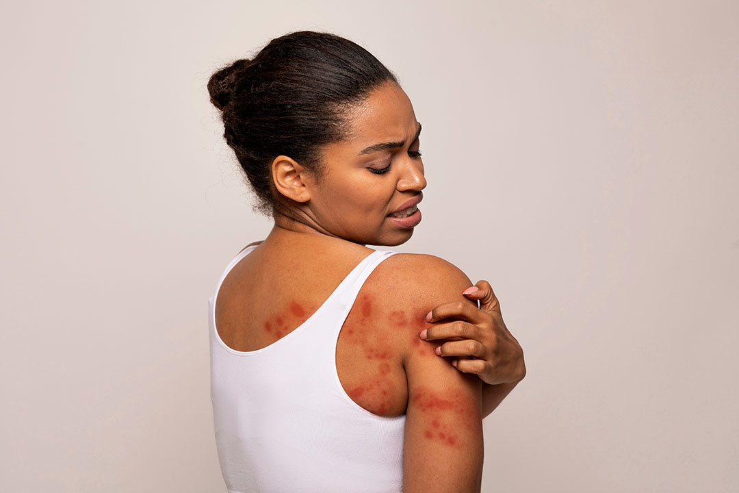 Living with Psoriasis: Advocating for Yourself