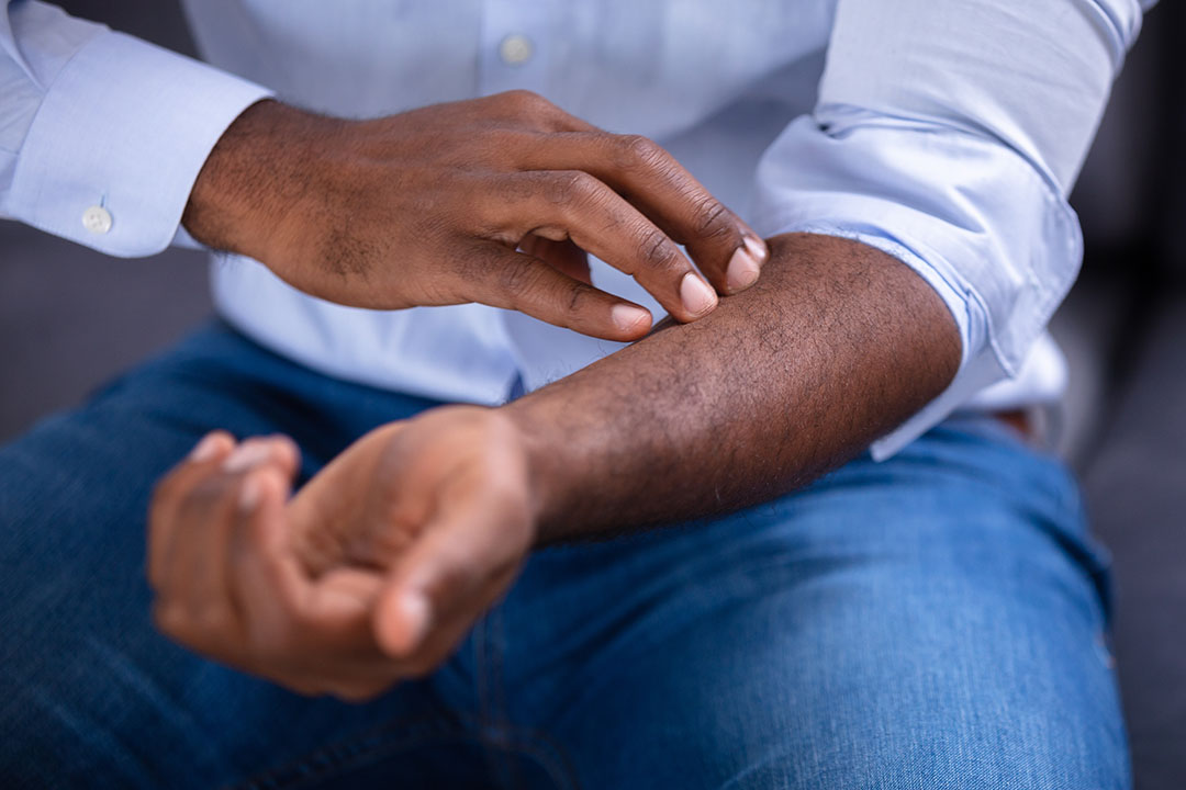 Psoriasis in Skin of Color: Know the Signs